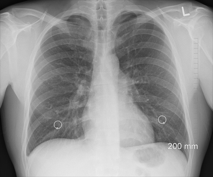 Як швидко легені відновлюються після COVID-19